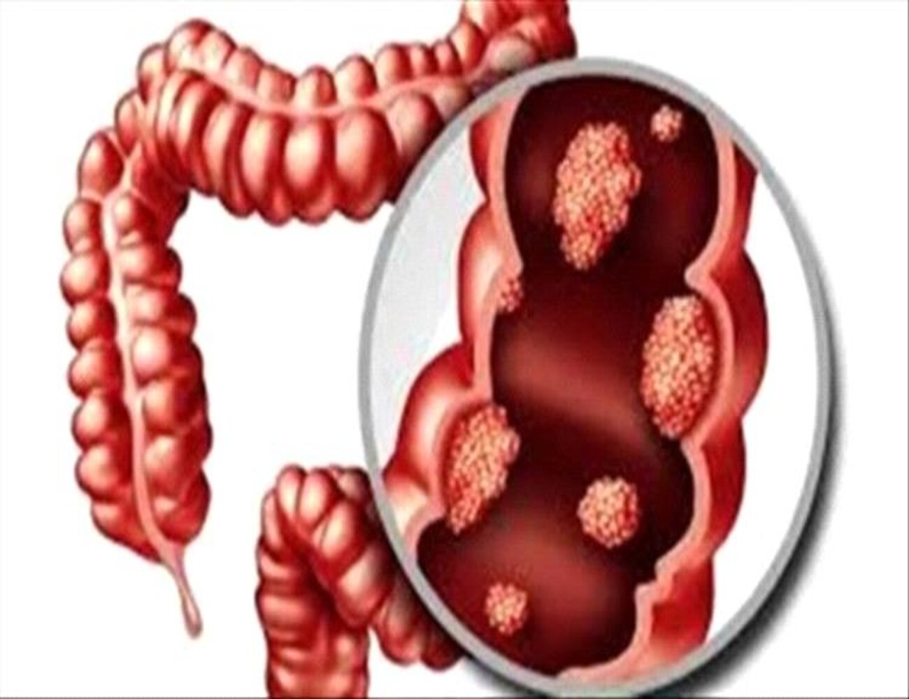 خمسة أمراض تزيد من خطر الإصابة بسرطان القولون