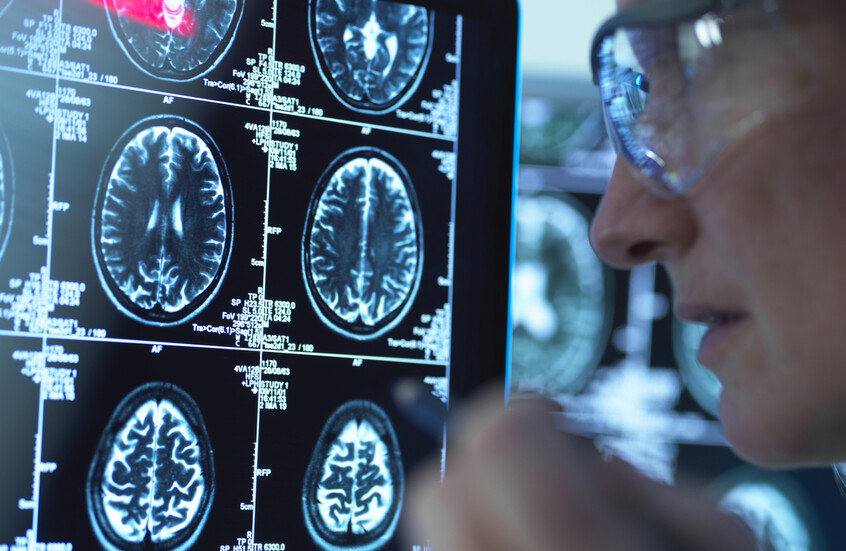 اكتشاف آلية طبيعية ثورية لمكافحة ألزهايمر عبر تعزيز مادة «NAD⁺» في الدماغ