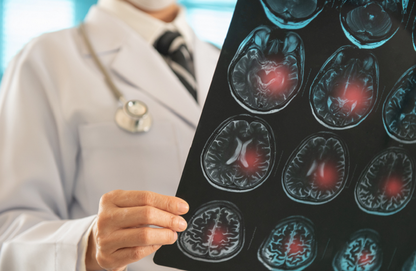 باحثو كامبريدج يبتكرون جهاز "Revoice" لإعادة النطق لمرضى السكتة الدماغية دون جراحة