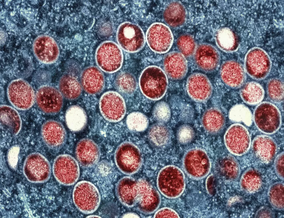الأمم المتحدة  تستنفر لجمع 18.5 مليون دولار لمواجهة جدري القردة في إفريقيا