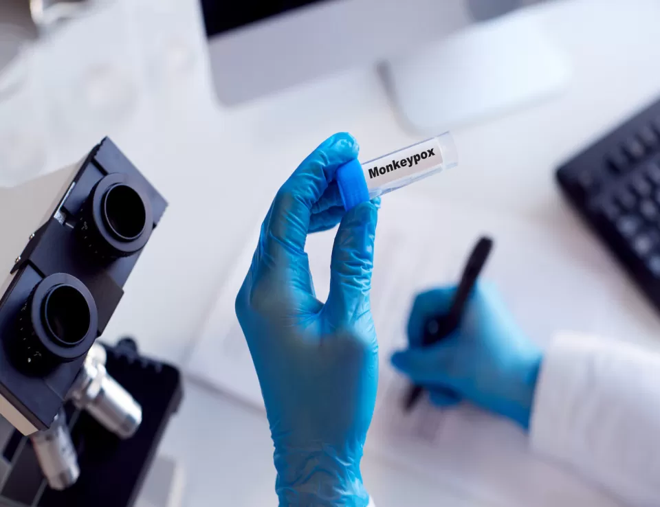 إصابة بجدري القرود لمقيم أجنبي في الأردن