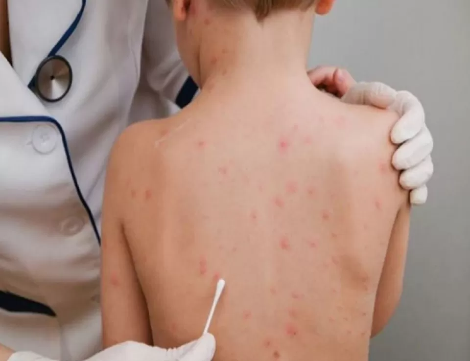 يونيسف تعلن عن طرح مناقصة طارئة لتأمين لقاحات جدري القردة 