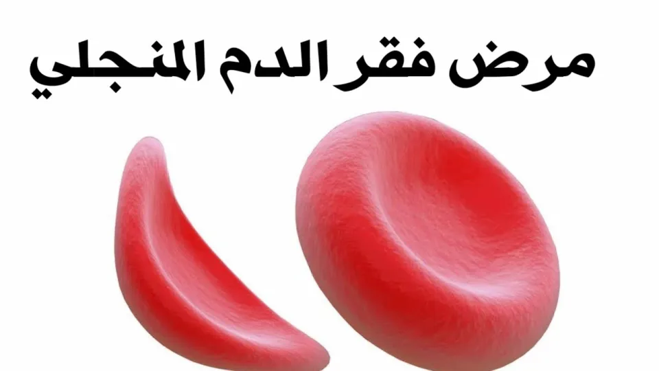 أبوظبي تسلط الضوء على جهودها في مكافحة فقر الدم المنجلي في اليوم العالمي للمرض