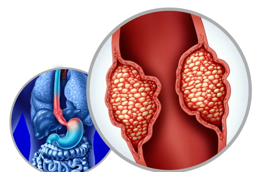 كبسولة طبية ذكية لرصد سرطان المريء مبكرًا دون جراحة