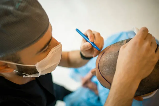 صناعة زراعة الشعر تحقق نمواً قياسياً بـ11 مليار دولار سنوياً